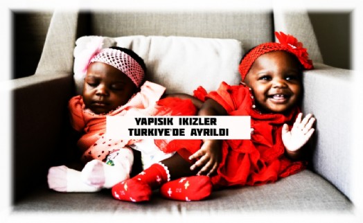 Yapışık İkizlerin Türkiye’de Yeniden Doğuş Hikayesi!
