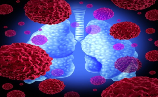 Bu belirtiler varsa zaman kaybetmeyin: Akciğer kanserinin 8 önemli sinyali!