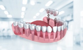 Ağız ve diş sağlığında implantın önemi